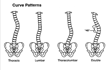 Image result for Common Types of scoliosis Curves