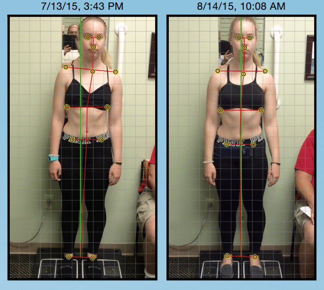 Posture analysis of patient after one week of intensive scoliosis therapy.
