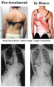 Milwaukee Brace vs New Scoliosis Braces: Which Is Better?