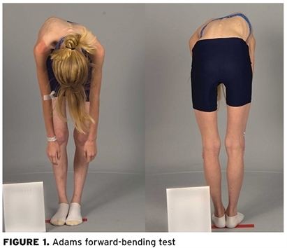 Adams foward-bending test to show signs of scoliosis