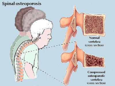 Understanding Dowager's Hump: Causes, Symptoms & Exercises