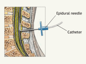 epidurals and scoliosis