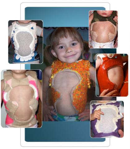 infantile scoliosis casting