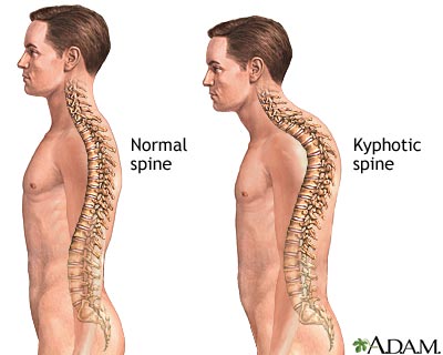 types of scoliosis - kyphoscoliosis