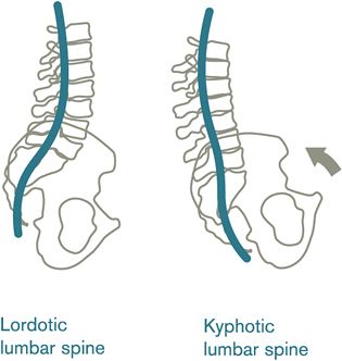 kyphosis in lumbar spine