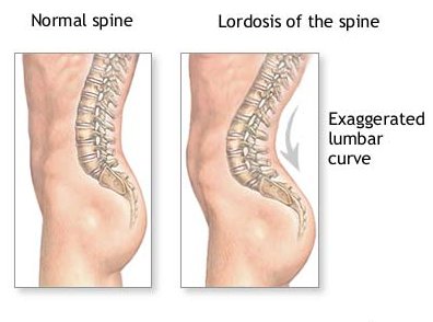 types of scoliosis - lordosis