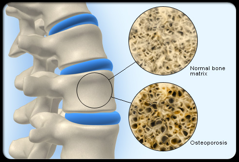 osteoporosis and scoliosis