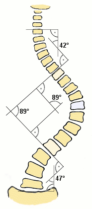 scoliosis cobb angle