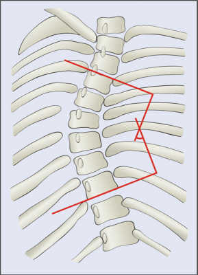 scoliosis cobb angle