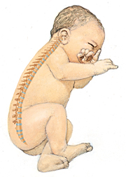 scoliosis in infants