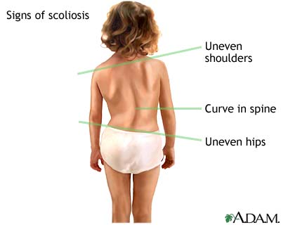 signs of scoliosis