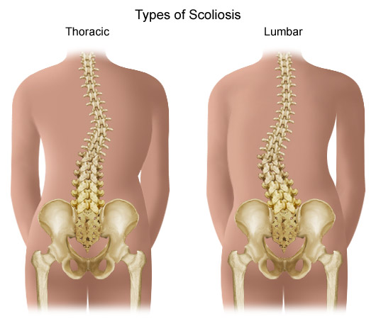 thoracic scoliosis_lumbar Scoliosis