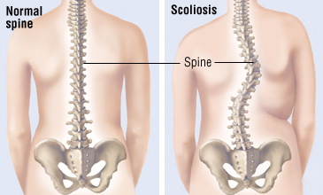 what is scoliosis - illustration