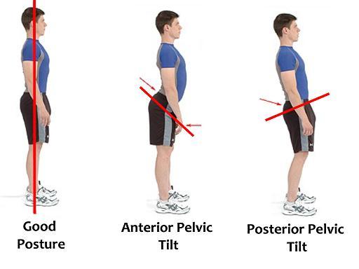 anterior pelvic tilt