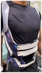 Person wearing a custom-fitted back brace for kyphosis, featuring a galaxy pattern and white straps over a black shirt.