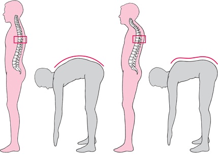 kyphosis symptoms and diagnosis