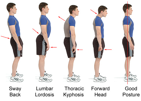 Sway Back Posture: A Common Postural Variation