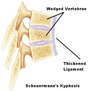 scheuermanns Kyphosis vertebral wedging 2