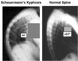 scheuermanns kyphosis treatment