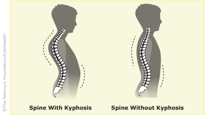 treatment for kyphosis