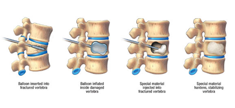 what is kyphoplasty lumbar lordosis treatment