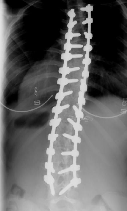 Scoliosis surgery X-ray