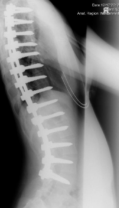 Scoliosis surgery lateral X-ray