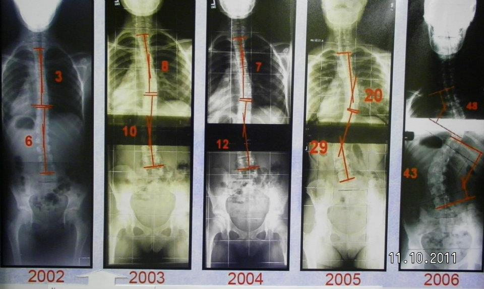 all LARGE scoliosis curves start off as small ones
