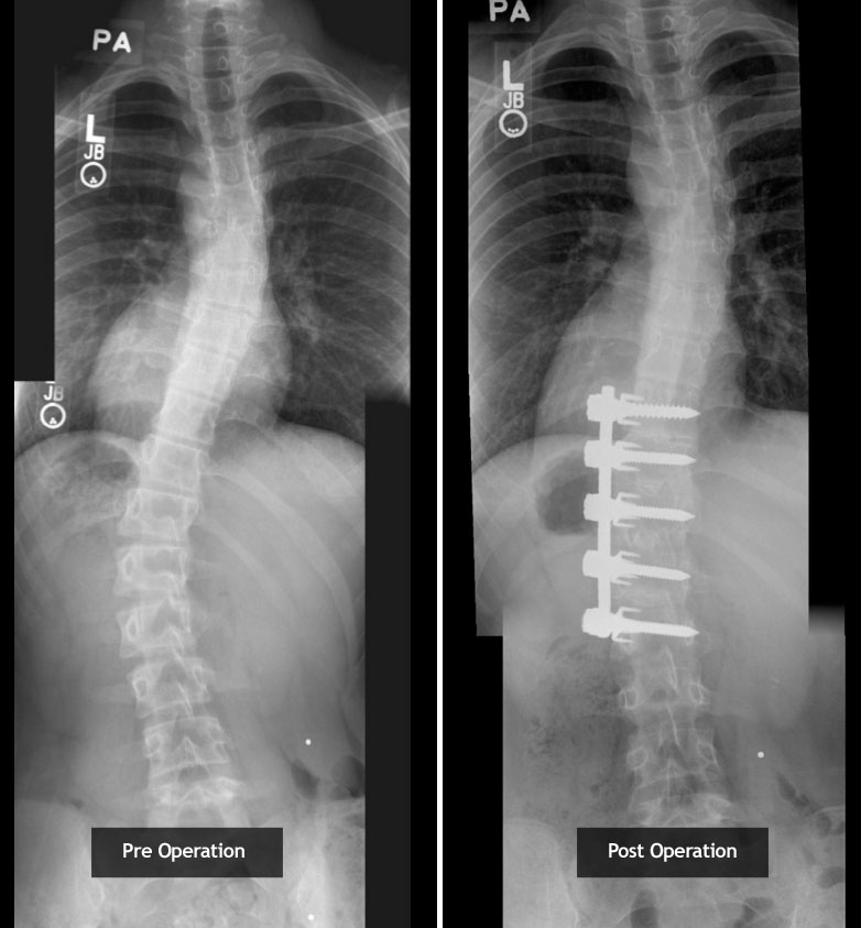 stacy lewis scoliosis xray