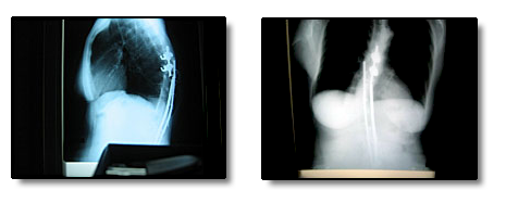 2 radiographs of an individual with broken Harrington rods.