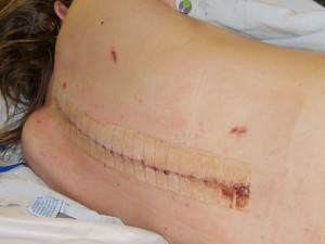 scoliosis surgery scar