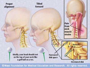 scoliosis forward head posture