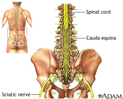 scoliosis sciatica