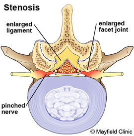 scoliosis and stenosis