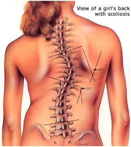 scoliosis shoulder pain