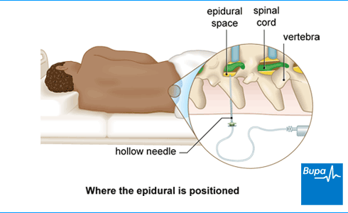 PCA and scoliosis surgery pain