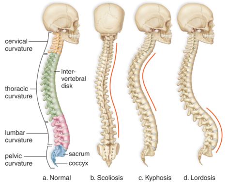 Normal spine vs kyphosis, lordosis, and scoliosis.