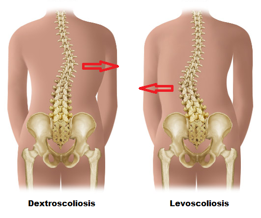 types of scoliosis - dextroscoliosis and levoscoliosis