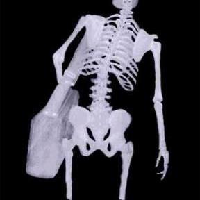 is scoliosis caused by carrying heavy bags