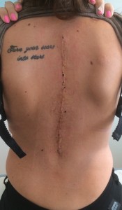 scoliosis scar tattoo