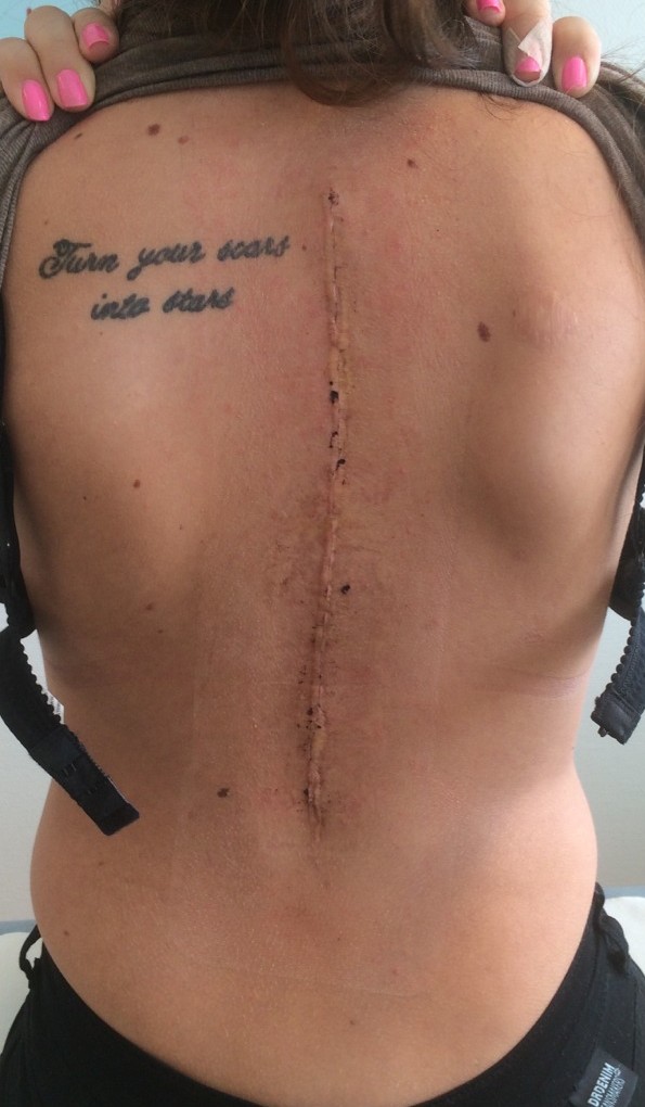 Scoliosis Surgery Scar Tattoo Be Confident Again  Studio Conceal