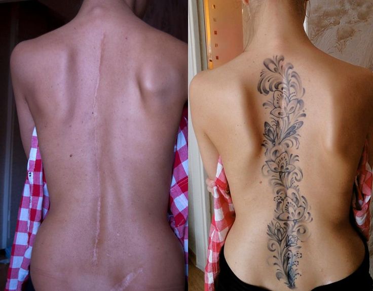 Can you get a spine tattoo if you have scoliosis