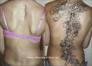 tatoo to cover up scoliosis scar