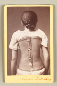 historical treatment of scoliosis