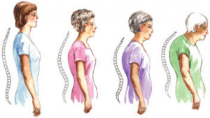 scoliosis in adult patients