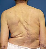 adult scoliosis symptoms