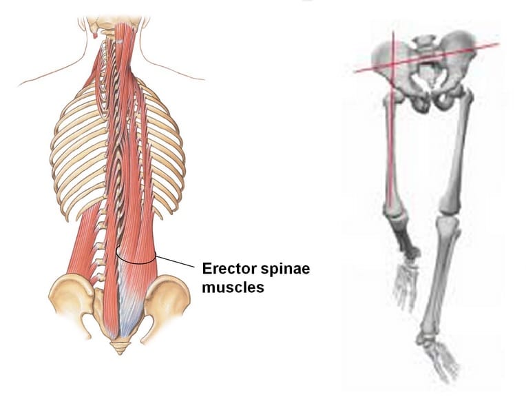 High Heels And Scoliosis Effects And Prevention