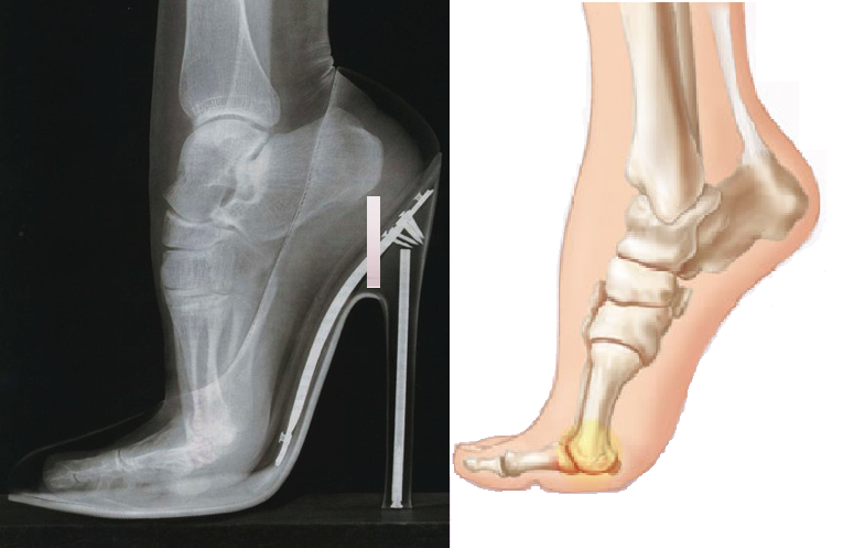 xray of foot in high heel