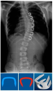 vertebral body stapling VBS