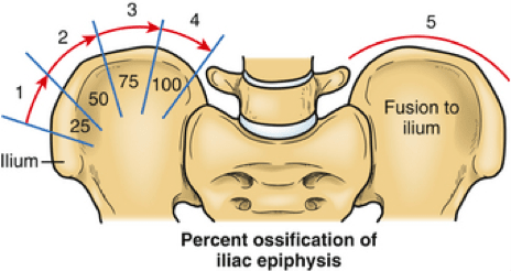 risser-sign-for-scoliosis-assessment